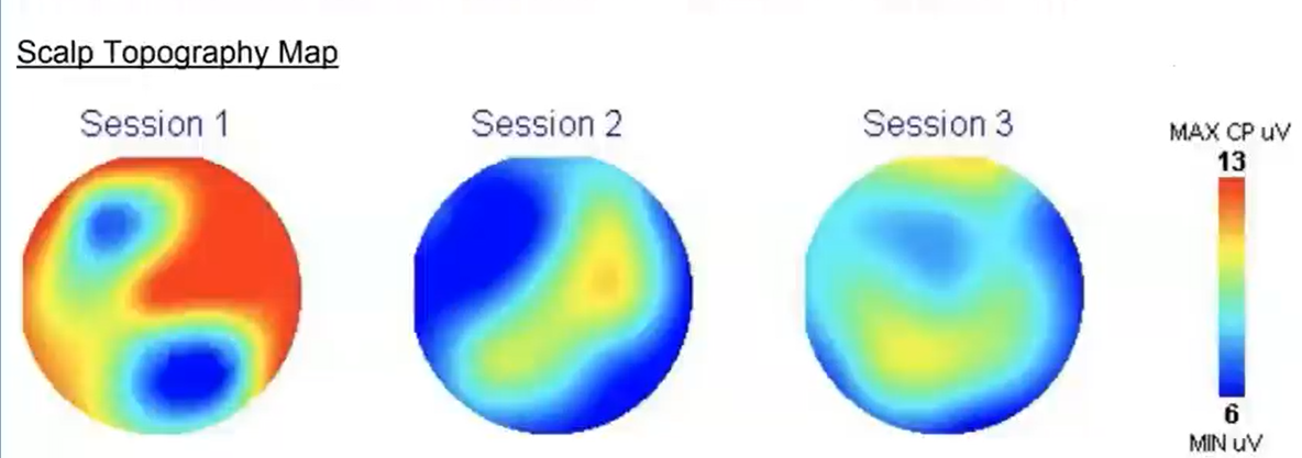 Scalp Topography Map